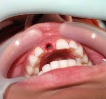 hole 