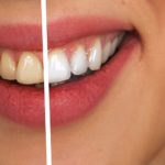 whitener teeth 